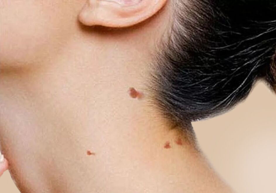 L'apparition de papillomes sur le cou après l'activation du VPH dans le corps. 