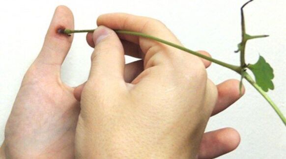 Cautérisation du papillome sur le doigt avec du jus de chélidoine. 
