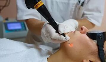 Une procédure efficace pour éliminer le papillome sur le visage avec un laser. 