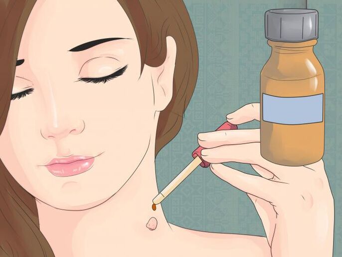 Utilisez le médicament sous forme de solution pour éliminer le papillome sur le cou. 