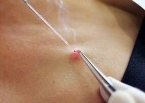 Élimination du laser