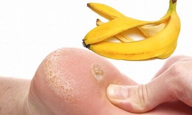 Banana Peel pour le traitement d'une verrue plantaire