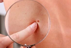 Raisons de l'apparition de papillomes sur le corps humain.