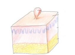 comment se débarrasser du papillome sur le corps