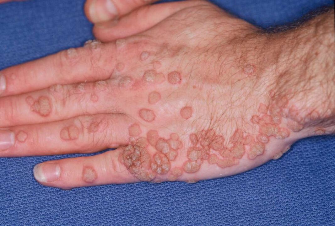 beaucoup de papillomes sur les mains