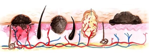 types de papillomes sur le corps humain