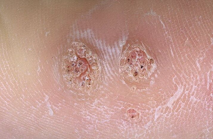 verrues sur le corps