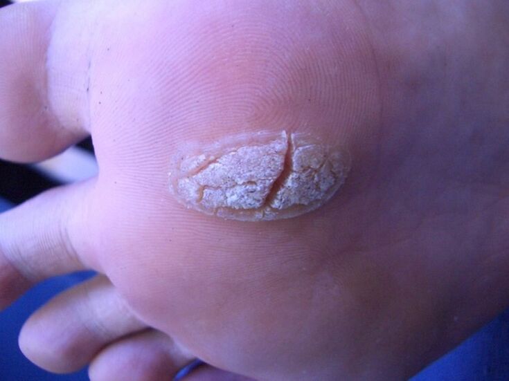 verrue sur la peau du pied